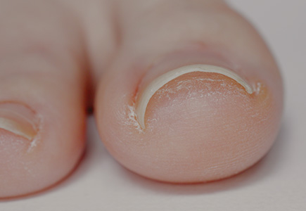 巻き爪・深爪